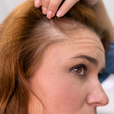 alopecia06A