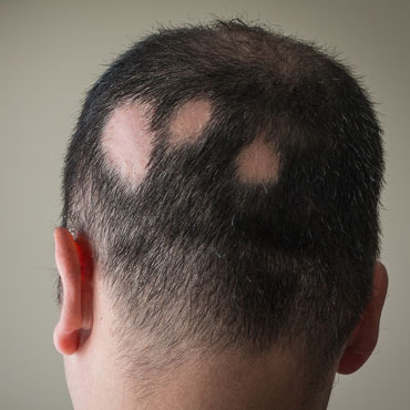 alopesia02