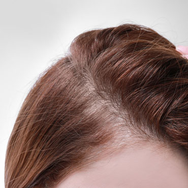 alopesia04